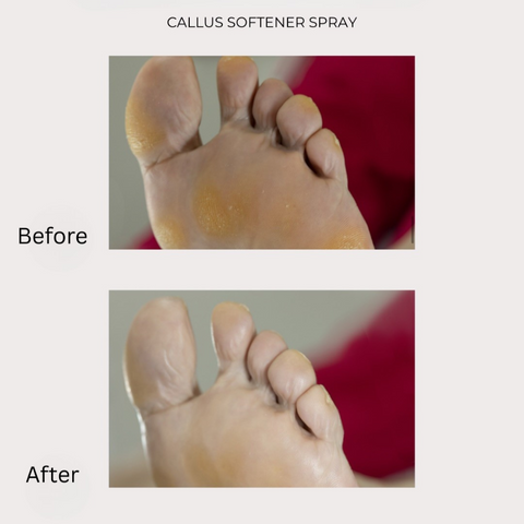 StraDerm Callus Softener Spray, 200 ml