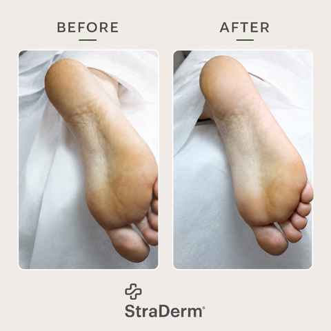 StraDerm Callus Softener Spray, 200 ml