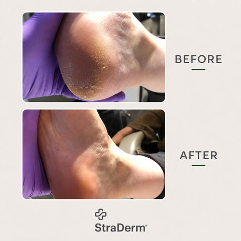 StraDerm Callus Softener Spray, 200 ml