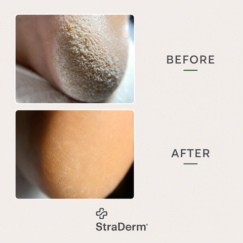 StraDerm Callus Softener Spray, 200 ml