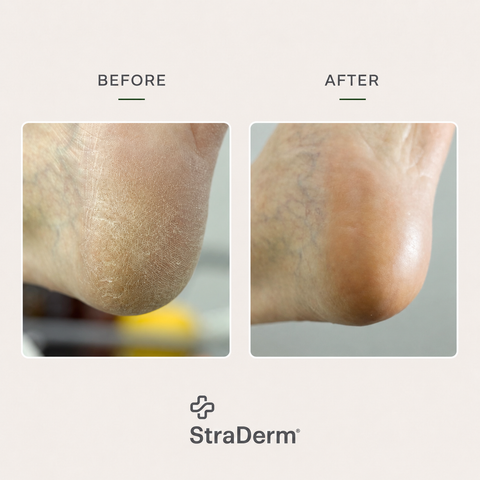 StraDerm Callus Softener Spray, 200 ml