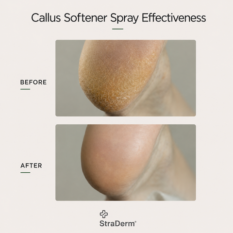 StraDerm Callus Softener Spray, 200 ml